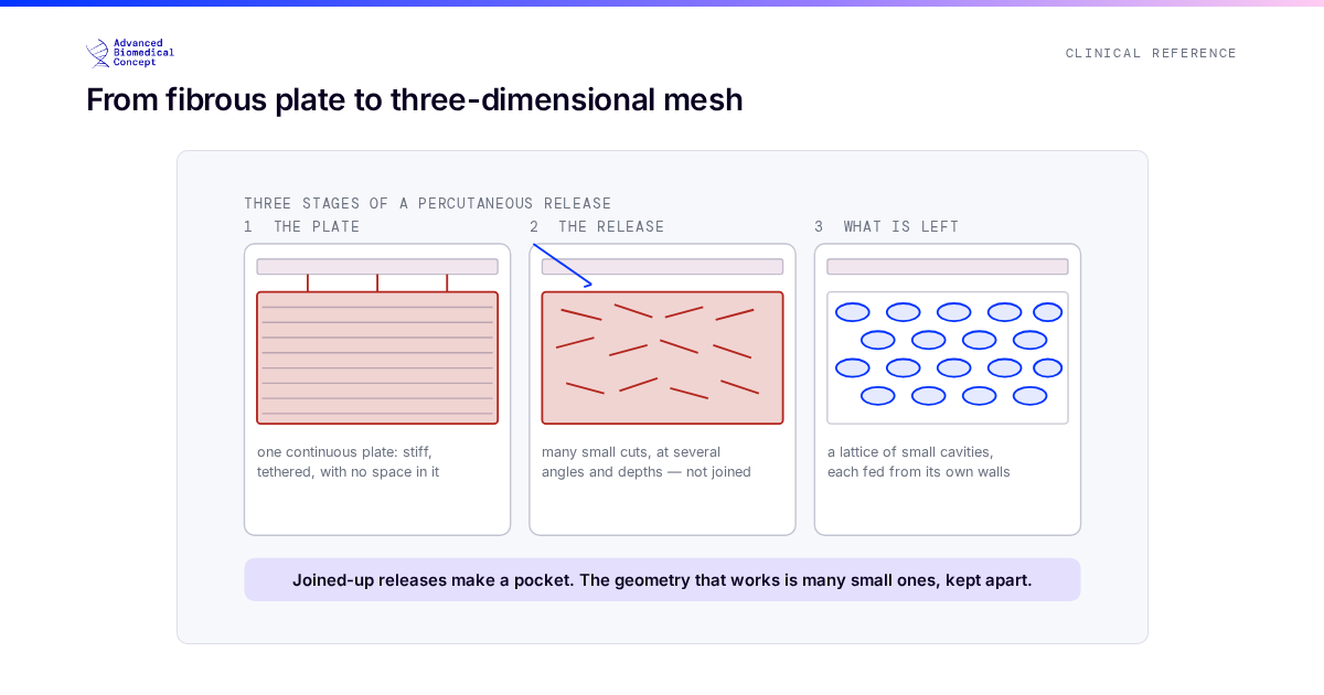 Three stages of a percutaneous release. First, scarred tissue as a continuous fibrous plate under the skin, stiff and tethered, with no space in it. Second, a fine needle passed through the skin at shallow angles making many small independent cuts through the fibrous bands, in several directions and at several depths, without joining them up. Third, the result: a lattice of small separate cavities held open by the tension that was previously locked in the plate, each cavity small enough to be fed from its own walls. The figure marks that the releases are deliberately not connected to one another.